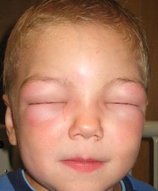 AngioedemaAllergy